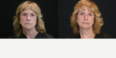 Exilis before and after photo