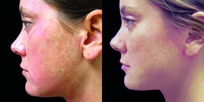 Fraxel Laser before and after photo