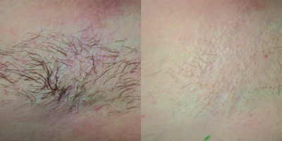 Laser Hair Removal before and after photo