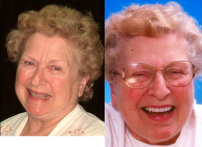 Lumineers before and after photo