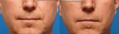 ArteFill before and after photo