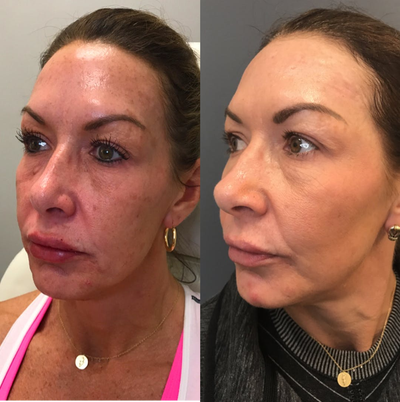 Dermabrasion before and after photo