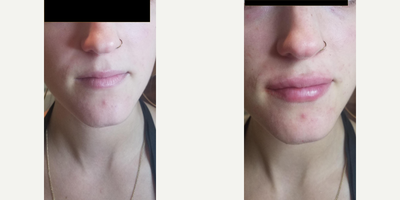Dermal Fillers before and after photo
