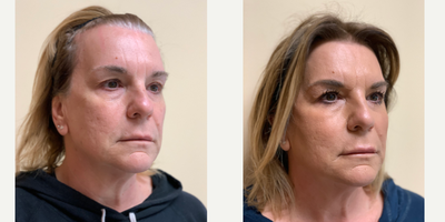 NovaThreads before and after photo