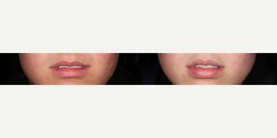 Restylane before and after photo