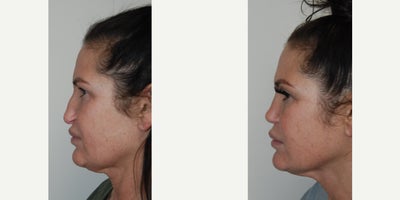 Rhinoplasty before and after photo