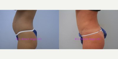 Tummy Tuck before and after photo