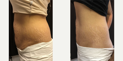 CoolSculpting before and after photo