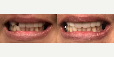 Dental Implants before and after photo