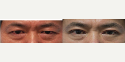 Eyelid Surgery before and after photo