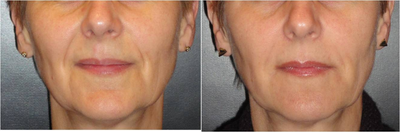 Juvederm before and after photo