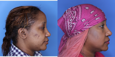 African American Rhinoplasty before and after photo