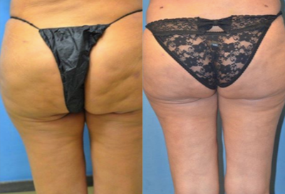 Cellfina before and after photo