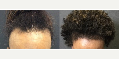 Hair Transplant before and after photo