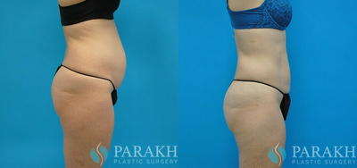 Liposuction before and after photo