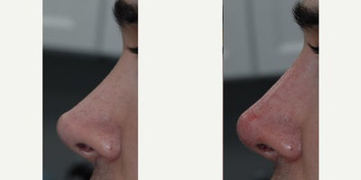 Nonsurgical Nose Job before and after photo