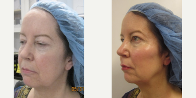 Radiesse before and after photo