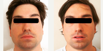 Buccal Fat Removal before and after photo