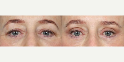 Eyelid Surgery before and after photo