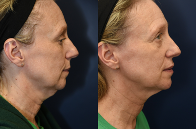 Ultherapy before and after photo