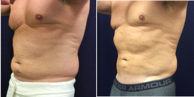 Vaser Liposuction before and after photo