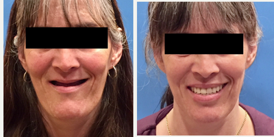 All-on-4 Dental Implants before and after photo