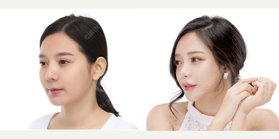 Canthoplasty before and after photo