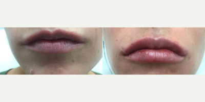 Juvederm before and after photo