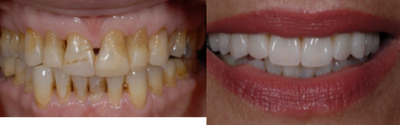 Porcelain Veneers before and after photo
