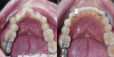 Clear Braces before and after photo