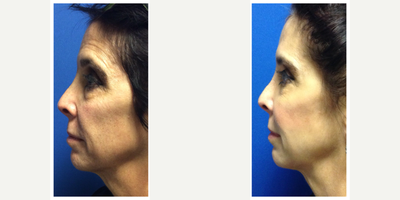 Dysport before and after photo