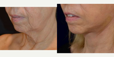 Facelift before and after photo