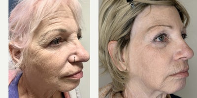 Fractional Laser before and after photo