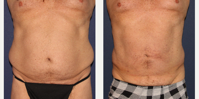 Liposculpture before and after photo