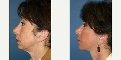 Facelift before and after photo