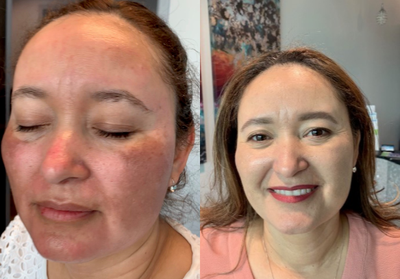 Microneedling before and after photo