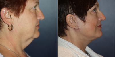 Neck Lift before and after photo