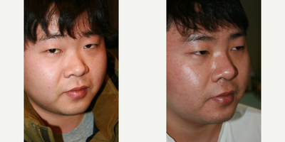 Rhinoplasty before and after photo
