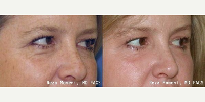 Skin Rejuvenation before and after photo