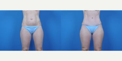 Tummy Tuck before and after photo