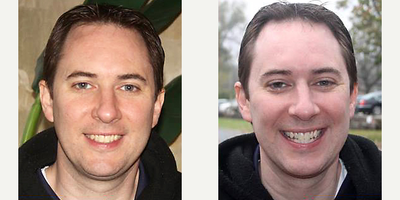Zoom Whitening before and after photo