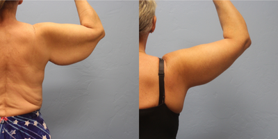 Arm Lift before and after photo