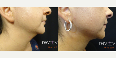 Kybella before and after photo