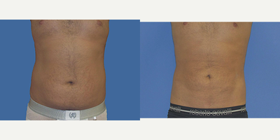 Liposuction before and after photo
