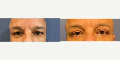 Eyelid Surgery before and after photo