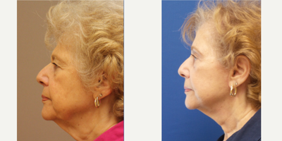 Facelift before and after photo