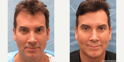 FUE Hair Transplant before and after photo