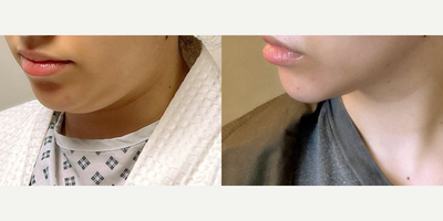Liposuction before and after photo