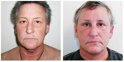 SMAS Facelift before and after photo