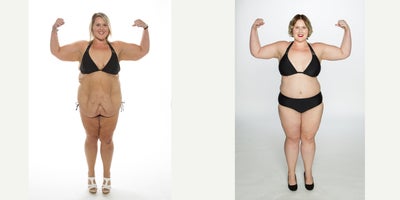 Body Lift before and after photo